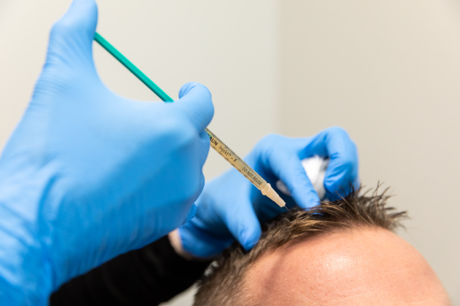PRP Scalp