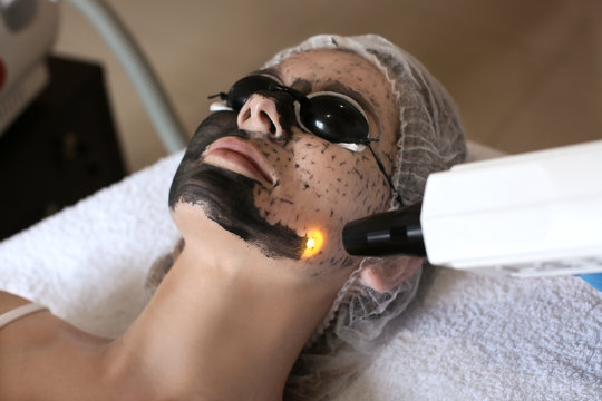 Carbon Peel Treatment